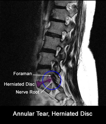 Disc Herniations – Neck Pain | Siegenthaler Active Release Therapy ...