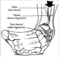 ankle-sprain sm